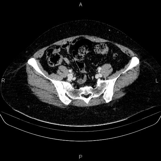 Adrenal cortical carcinoma (Radiopaedia 84882-100379 Axial C+ portal venous phase 73).jpg