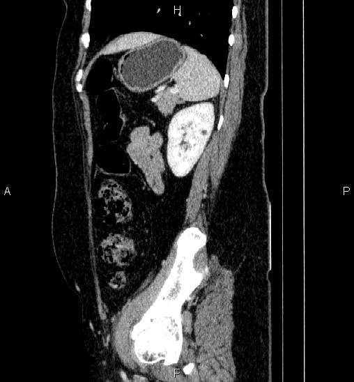 Adrenal cortical carcinoma (Radiopaedia 84882-100379 Sagittal C+ portal venous phase 68).jpg