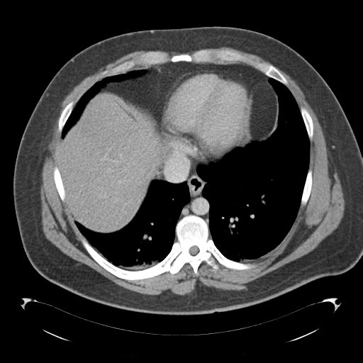 File:Adrenal cyst (Radiopaedia 45625-49776 Axial C+ portal venous phase 11).png