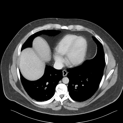 File:Adrenal cyst (Radiopaedia 45625-49777 Axial C+ portal venous phase 12).png