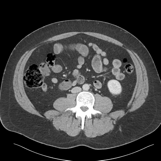Adrenal cyst (Radiopaedia 45625-49777 Axial C+ portal venous phase 59).png