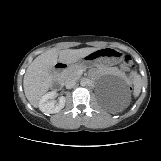 Adrenal cyst (Radiopaedia 64869-73813 Axial C+ portal venous phase 28).jpg