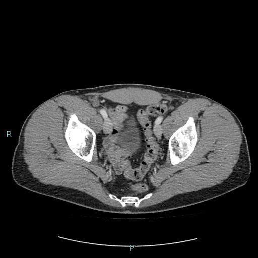 Adrenal cystic lymphangioma (Radiopaedia 83161-97534 Axial C+ portal venous phase 87).jpg