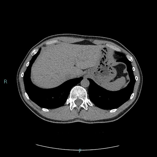 File:Adrenal cystic lymphangioma (Radiopaedia 83161-97534 Axial non-contrast 19).jpg