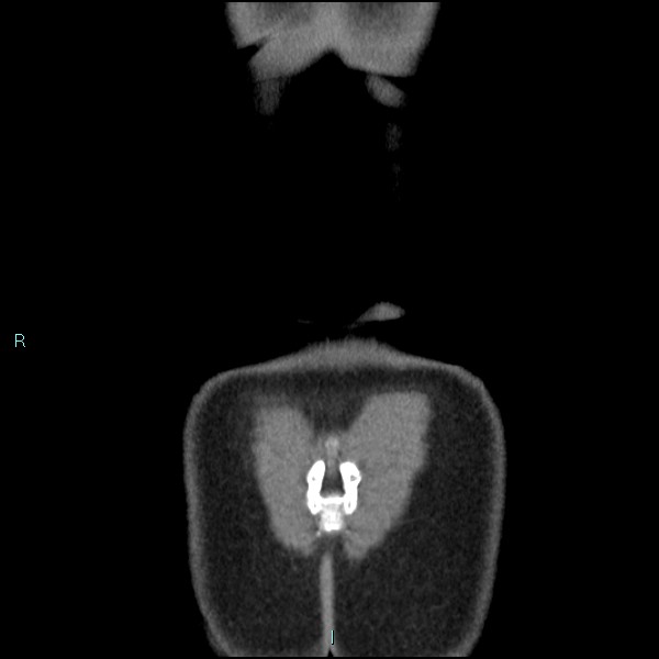 Adrenal cystic lymphangioma (Radiopaedia 83161-97534 Coronal C+ portal venous phase 78).jpg