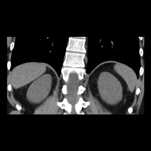 File:Adrenal gland trauma (Radiopaedia 81351-95079 Coronal non-contrast 67).jpg