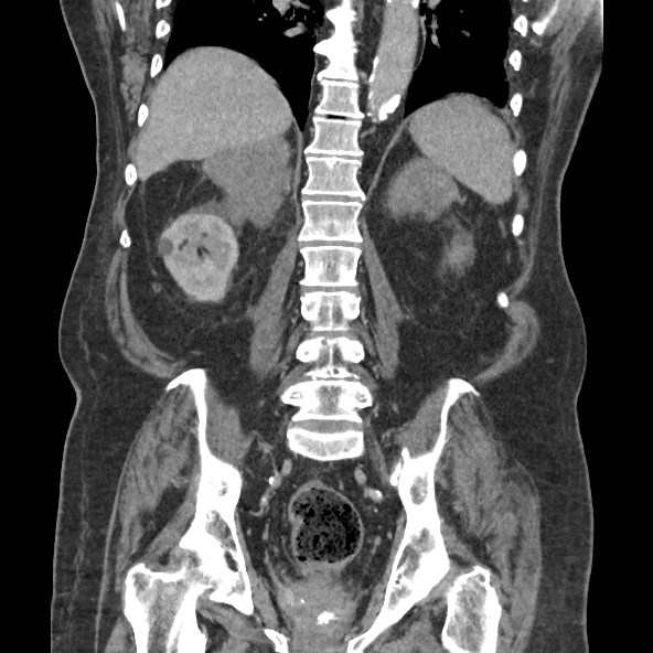 Adrenal lymphoma (Radiopaedia 84145-99415 Coronal C+ portal venous phase 62).jpg