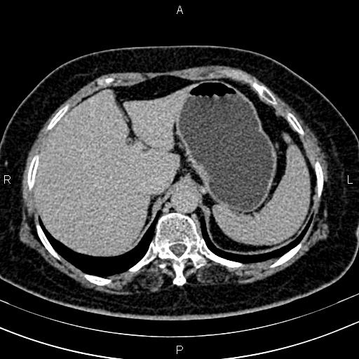 Adrenal myelolipoma (Radiopaedia 82742-96986 Axial renal excretory phase 25).jpg