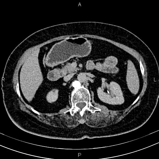 Adrenal myelolipoma (Radiopaedia 82742-96986 Axial renal excretory phase 53).jpg