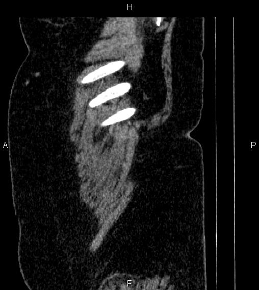 File:Adrenal myelolipoma (Radiopaedia 84319-99617 Sagittal renal cortical phase 1).jpg
