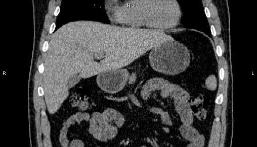 Adrenal myelolipoma (Radiopaedia 84321-99619 Coronal non-contrast 26).jpg