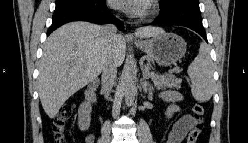File:Adrenal myelolipoma (Radiopaedia 84321-99619 Coronal non-contrast 44).jpg