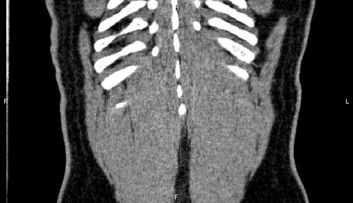 Adrenal myelolipoma (Radiopaedia 84321-99619 Coronal non-contrast 74).jpg