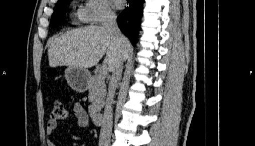 Adrenal myelolipoma (Radiopaedia 84321-99619 Sagittal non-contrast 49).jpg