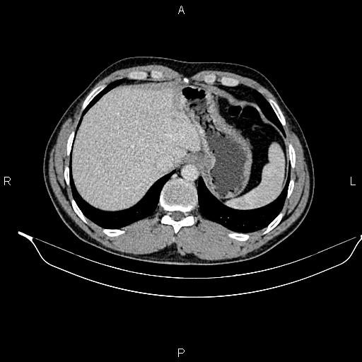 Adrenal myelolipoma (Radiopaedia 87794-104246 Axial renal cortical phase 18).jpg