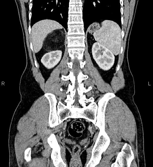 Adrenal myelolipoma (Radiopaedia 87794-104246 Coronal renal cortical phase 48).jpg