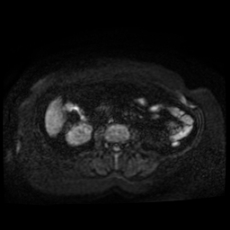 File:Adrenal myelolipoma - MRI (Radiopaedia 83249-97646 Axial DWI 22).jpg