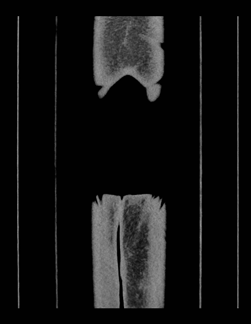 Adrenal myelolipoma - bilateral (Radiopaedia 74805-85810 Coronal C+ portal venous phase 23).jpg