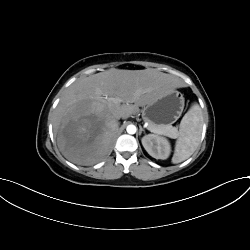 File:Adrenocortical carcinoma (Radiopaedia 87281-103569 Axial C+ arterial phase 26).jpg