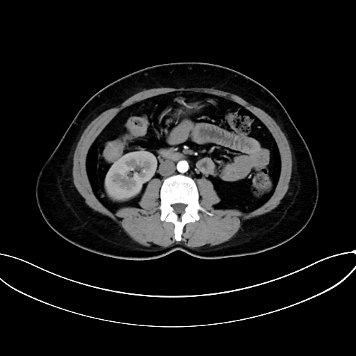 Adrenocortical carcinoma (Radiopaedia 87281-103569 Axial C+ arterial phase 45).jpg