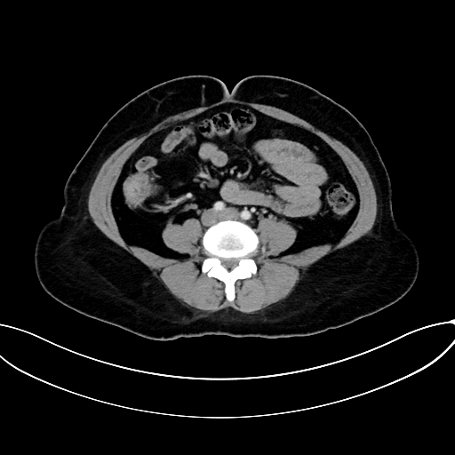 Adrenocortical carcinoma (Radiopaedia 87281-103569 Axial C+ portal venous phase 55).jpg