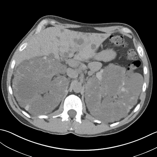 File:Adult polycystic kidney disease (Radiopaedia 47866-52626 Axial non-contrast 23).png