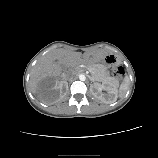 Adult polycystic kidney disease (Radiopaedia 48845-53876 Axial renal cortical phase 16).jpg