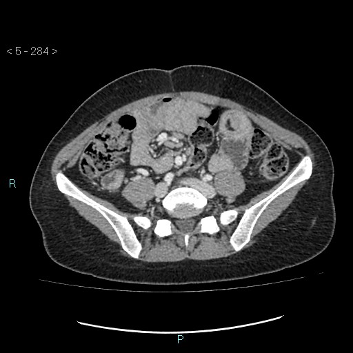 Adult transient intestinal intussusception (Radiopaedia 34853-36310 Axial C+ portal venous phase 64).jpg