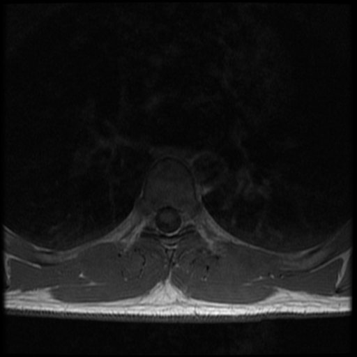 File:Aggressive vertebral hemangioma (Radiopaedia 39937-42404 Axial T1 22).png