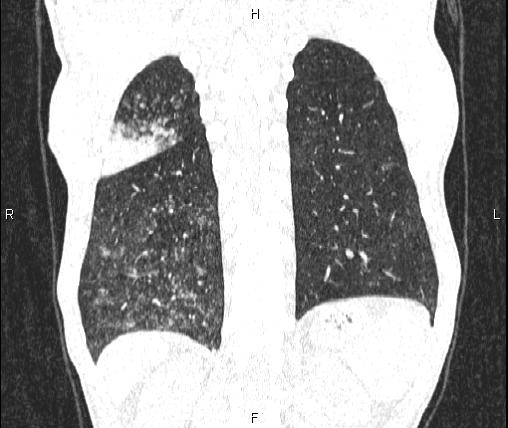 File:Air bronchogram in pneumonia (Radiopaedia 85719-101512 Coronal lung window 48).jpg