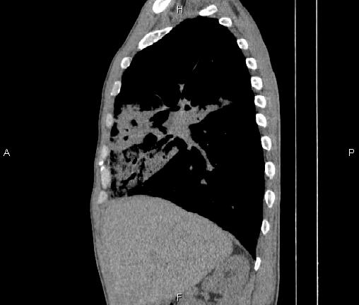 Air bronchogram in pneumonia (Radiopaedia 85719-101512 F 30).jpg