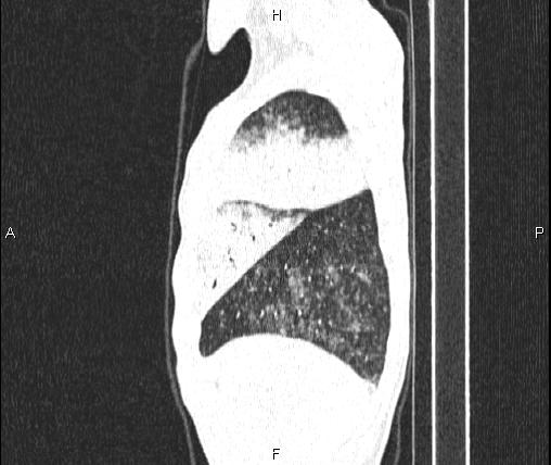 Air bronchogram in pneumonia (Radiopaedia 85719-101512 Sagittal lung window 14).jpg