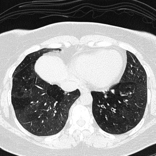 File:Air trapping in small airway disease (Radiopaedia 61685-69694 Axial lung window 133).jpg