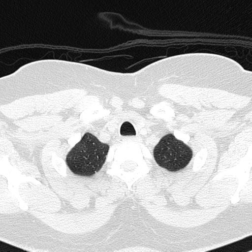 Air trapping in small airway disease (Radiopaedia 61685-69694 Axial lung window 14).jpg