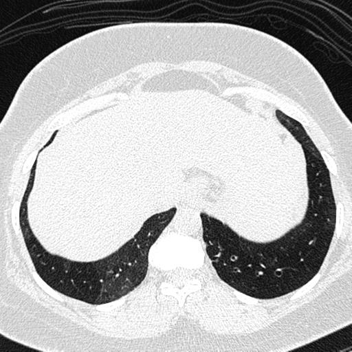 Air trapping in small airway disease (Radiopaedia 61685-69694 Axial lung window 168).jpg