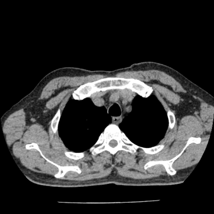 Airway foreign body in adult (Radiopaedia 85907-101779 Axial liver window 12).jpg