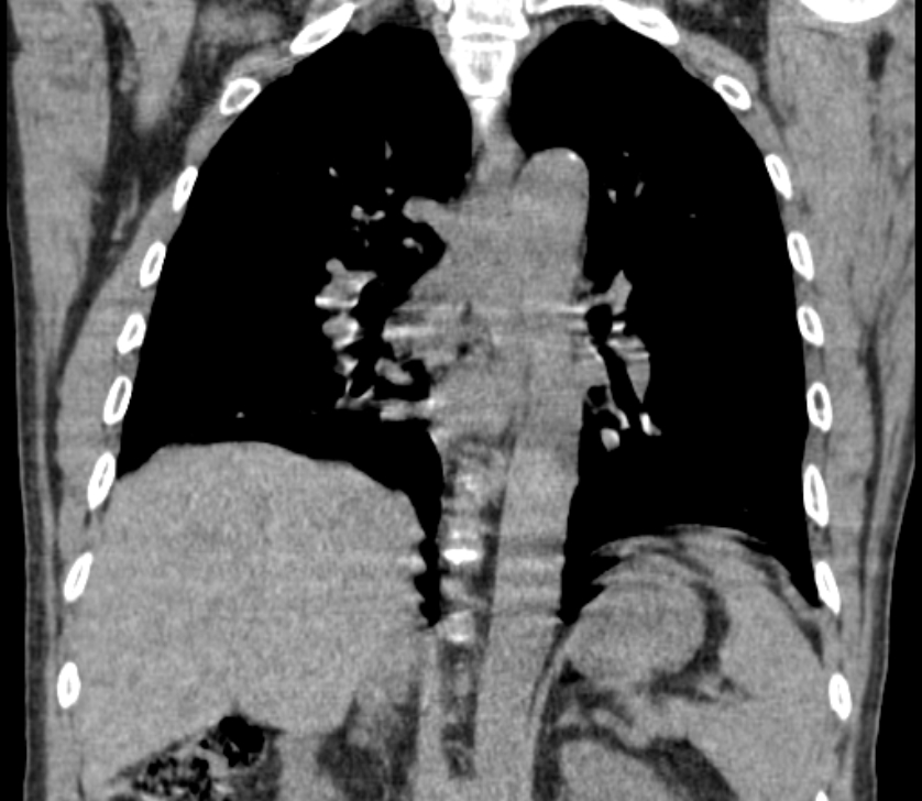 Airway foreign body in adult (Radiopaedia 85907-101779 Coronal liver window 168).jpg