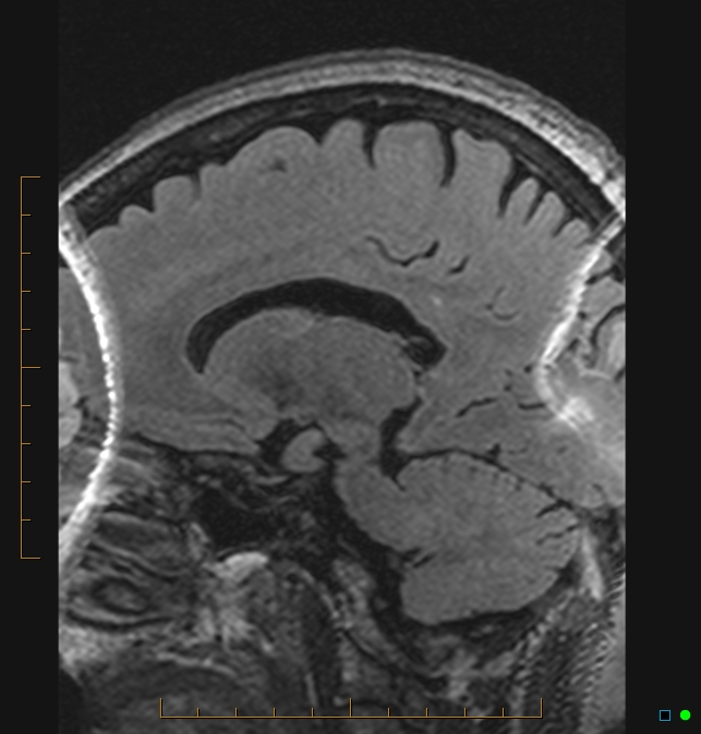 Aliasing artifact causing a spurious cerebellar lesion (Radiopaedia 48783-53810 Sagittal FLAIR 23).jpg