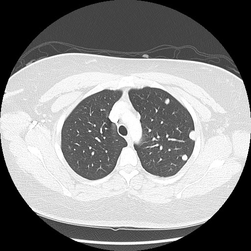 Alveolar soft part sarcoma - right leg (Radiopaedia 59432-67091 Axial lung window 30).jpg