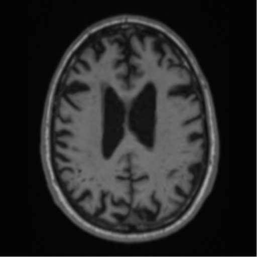 Alzheimer's disease- with Gerstmann syndrome and dressing apraxia (Radiopaedia 54882-61150 Axial T1 50).png