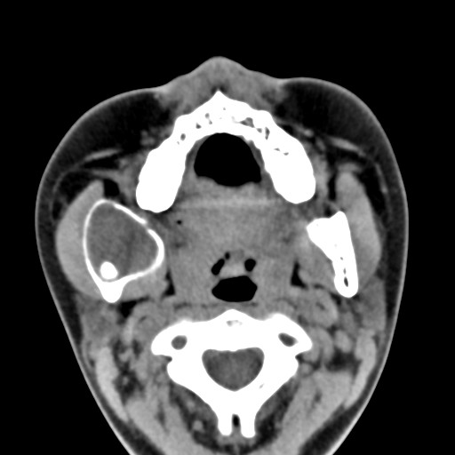 File:Ameloblastoma (Radiopaedia 26645-26793 Axial C+ delayed 23).jpg