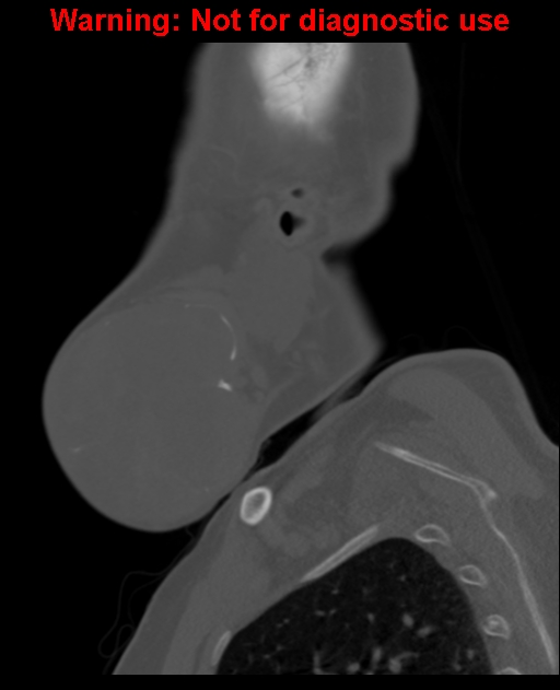 Ameloblastoma (Radiopaedia 33126-34164 Sagittal bone window 16).jpg