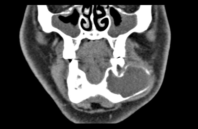 Ameloblastoma (Radiopaedia 33677-34806 Coronal non-contrast 20).png