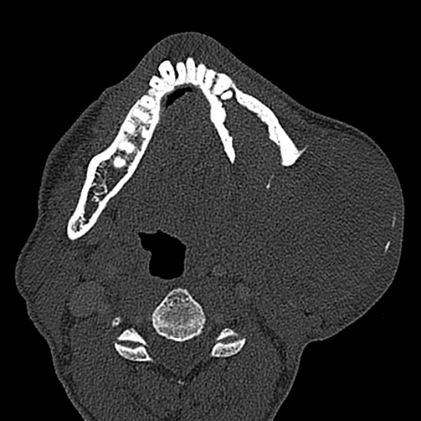 Ameloblastoma (Radiopaedia 51921-57766 Axial bone window 61).jpg