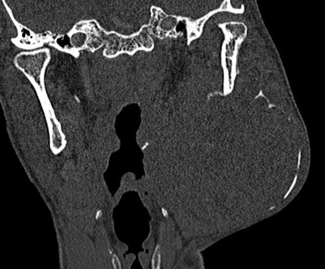 Ameloblastoma (Radiopaedia 51921-57766 Coronal bone window 179).jpg