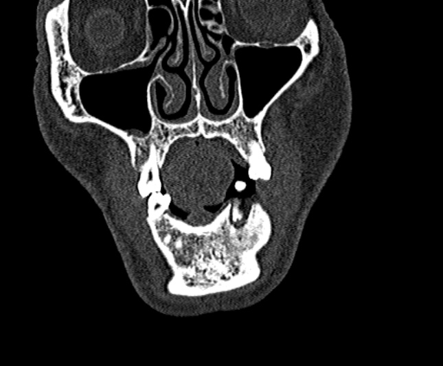 Ameloblastoma (Radiopaedia 51921-57766 Coronal bone window 45).jpg