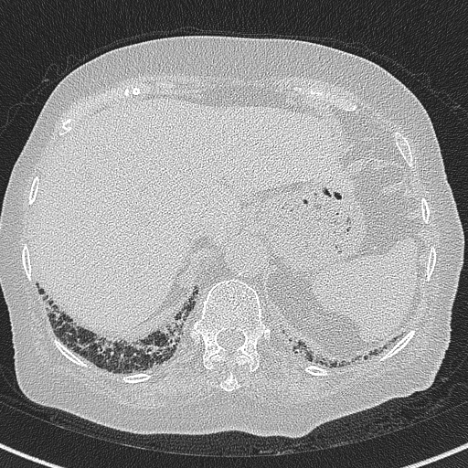 Amiodarone-induced pulmonary fibrosis (Radiopaedia 82355-96460 Axial lung window 62).jpg