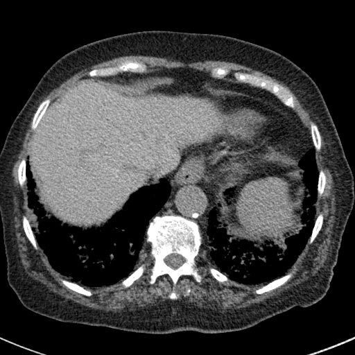 File:Amiodarone-induced pulmonary fibrosis (Radiopaedia 82355-96460 Axial non-contrast 50).jpg