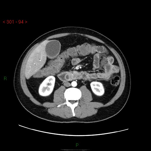 Ampullary carcinoma (Radiopaedia 56396-63056 B 40).jpg