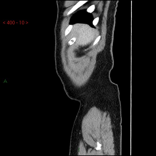 Ampullary carcinoma (Radiopaedia 56396-63056 D 9).jpg